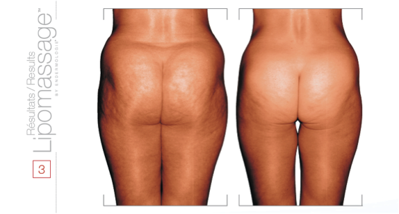 Cellulite